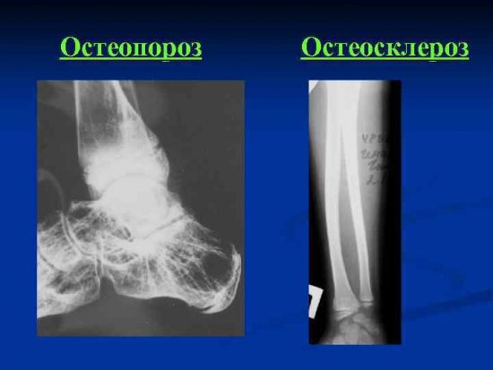 Снимок остеопороза и остеосклероза