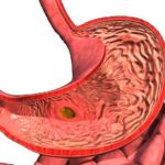 Эрозивные изменения слизистой кишечника и желудка
