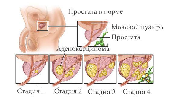 Стадии аденокарциномы предстательной железы