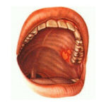 Воспаление слизистой полости рта