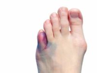 Травмы пальца на ноге: особенности лечения thumbnail