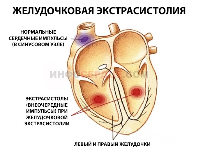 Желудочные экстрасистолы. Экстрасистол желудочка сердца что это. Желудочковая аритмия. Экстрасистолическая аритмия. Желудочковая экстрасистолия.