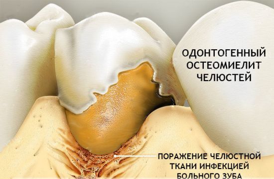 Одонтогенный остеомиелит