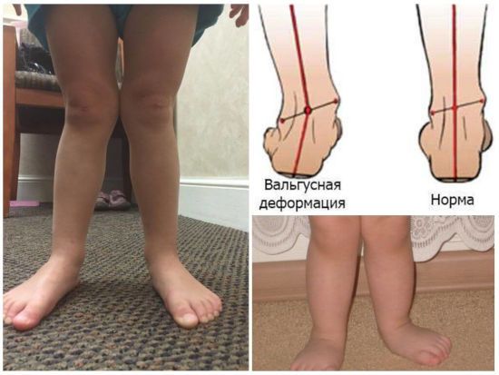 Кривые ноги у ребенка