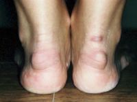 Боль в икрах ног у женщин