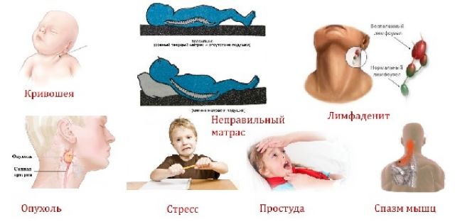 Боли в шее после сна у детей