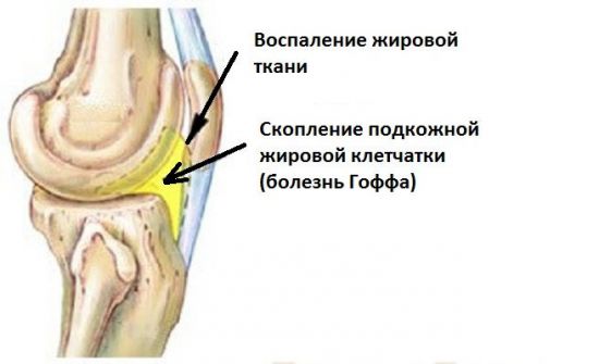 Воспаление жировой ткани в колене