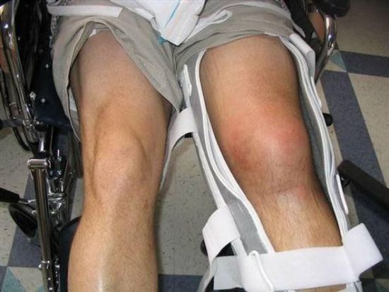 Зафиксированный коленный сустав