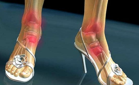 Боль в голеностопе при ходьбе на каблуках