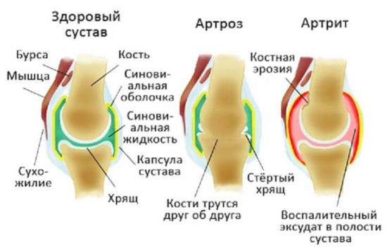 Артроз и артрит