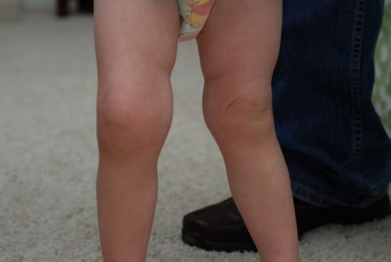 Артрит коленных суставов у ребенка 