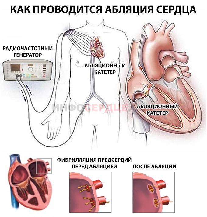 Рча предсердий. Радиочастотная катетерная абляция сердца. Катетерная абляция фибрилляции предсердий. Радиочастотная абляция при желудочковой экстрасистолии. Катетерная абляция сердца что это такое.