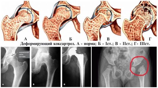 Рентген-снимок тазобедренного сустава