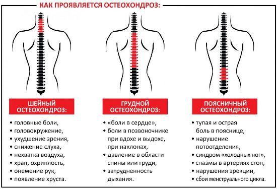 Симптомы остеохондроза