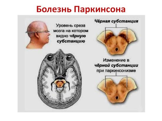 Мозг при Паркинсона