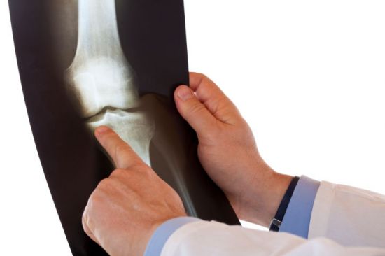 Рентген-снимок колена
