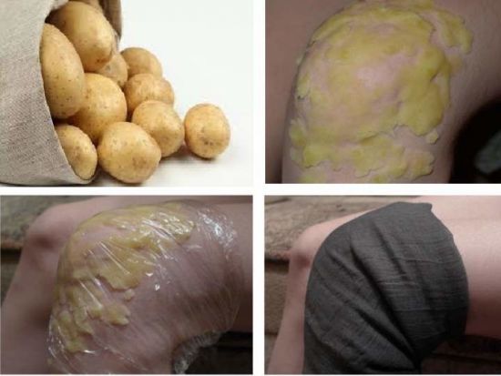 Картофельный компресс на колено