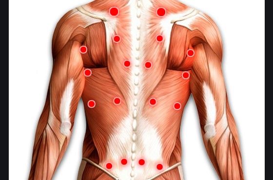 Размещение триггерных точек при миозите спины
