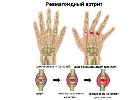 Ревматоидный артрит пальцев